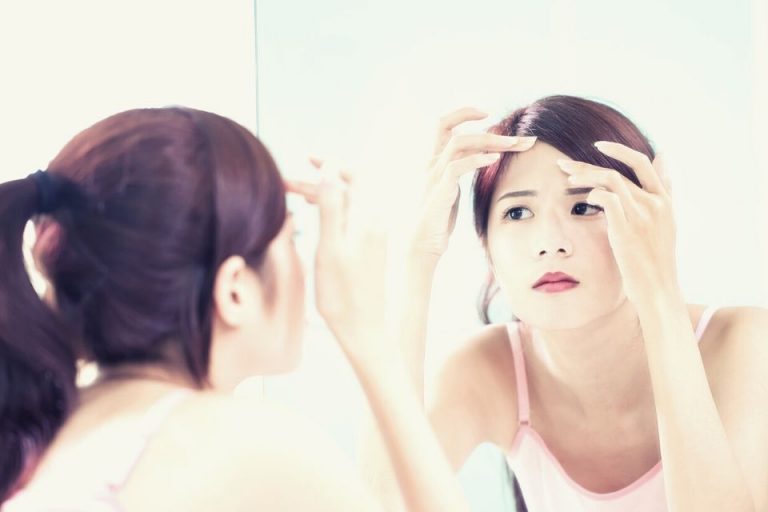 How To Get Rid of Forehead Acne.